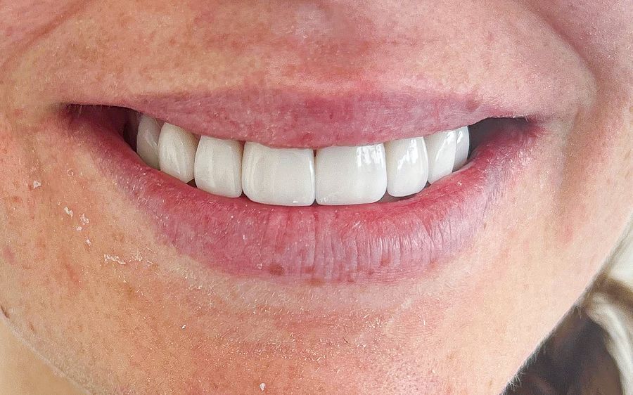 composite veneers after - 3dental